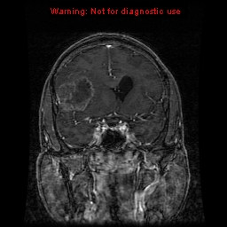 File:Bronchogenic carcinoma brain metastasis (Radiopaedia 9286-9969 Coronal T1 26).jpg