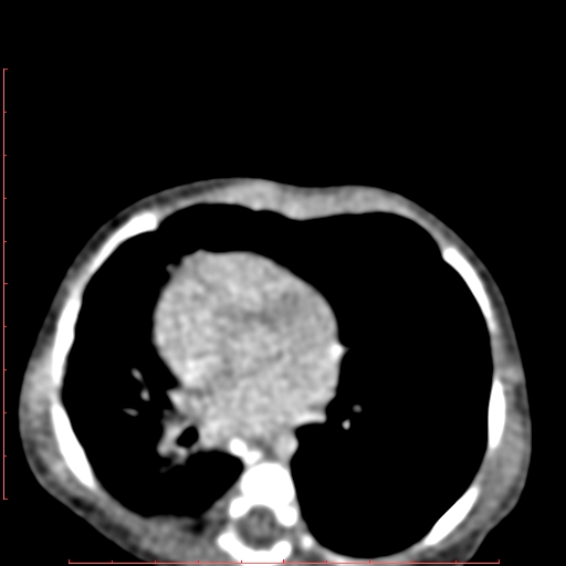 Bronchogenic cyst (Radiopaedia 78599-91409 B 117).jpg