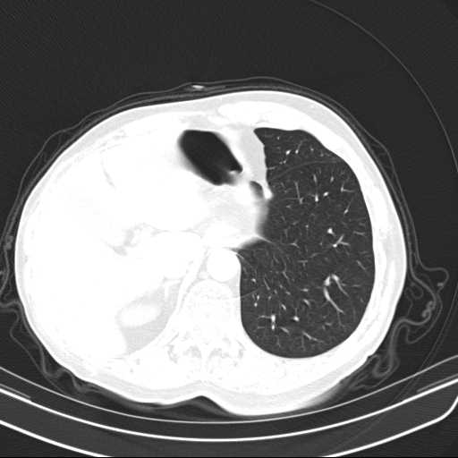 Bronchopleural fistula - postoperative complication (Radiopaedia 21020-20947 Axial lung window 49).jpg