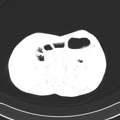 Bronchopleural fistula secondary to tuberculosis (Radiopaedia 20415-20322 Axial lung window 68).jpg