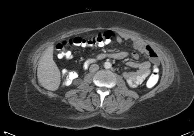 File:Brown tumors compressing the spinal cord (Radiopaedia 68442-77988 E 60).jpg