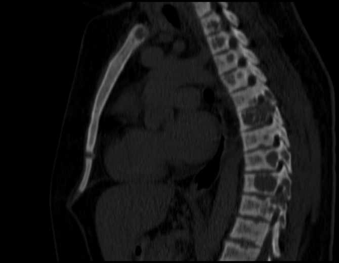 Brown tumors compressing the spinal cord (Radiopaedia 68442-77988 Sagittal bone window 31).jpg
