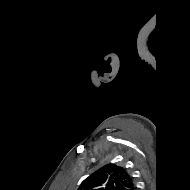 Buccal fat pad arteriovenous malformation (Radiopaedia 70936-81144 C 18).jpg