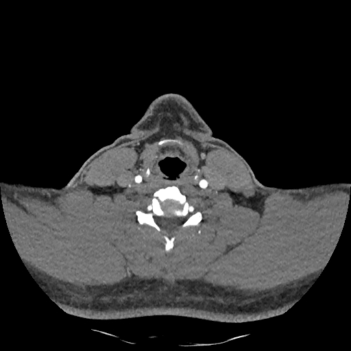 Buccal fat pad arteriovenous malformation (Radiopaedia 70936-81144 D 109).jpg