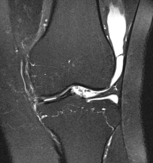 File:Bucket handle tear - medial meniscus (Radiopaedia 79028-91942 Coronal PD fat sat 13).jpg