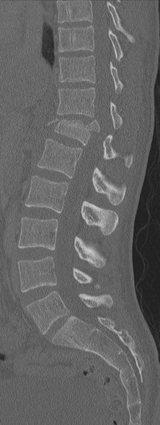 Burst fracture - T12 with conus compression (Radiopaedia 56825-63647 Sagittal bone window 43).png