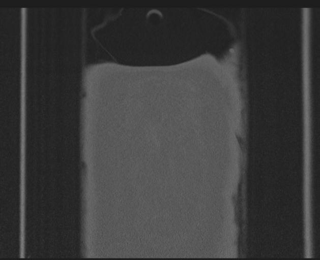 File:Burst fracture - thoracic spine (Radiopaedia 30238-30865 Coronal bone window 164).jpg