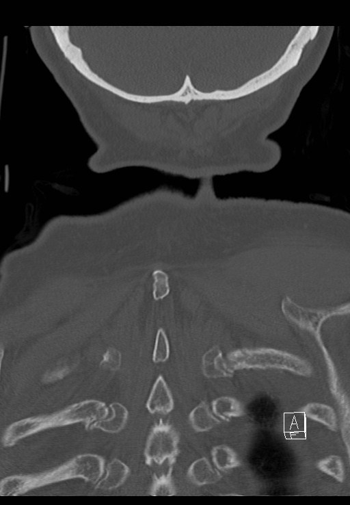 C1 and C2 (peg) fractures (Radiopaedia 36618-38184 Coronal bone window 52).jpg