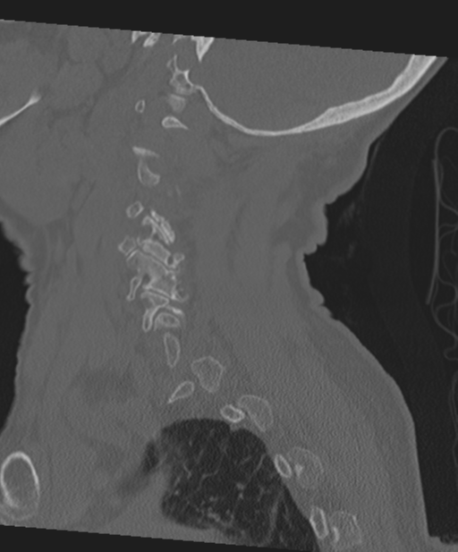 C2 fracture with vertebral artery dissection (Radiopaedia 37378-39199 Sagittal bone window 22).png