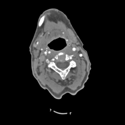 File:C2 fracture with vertebral artery dissection (Radiopaedia 37378-39200 A 152).png
