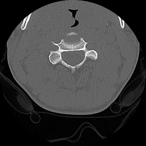 File:C5 facet fracture (Radiopaedia 58374-65499 Axial bone window 32).jpg