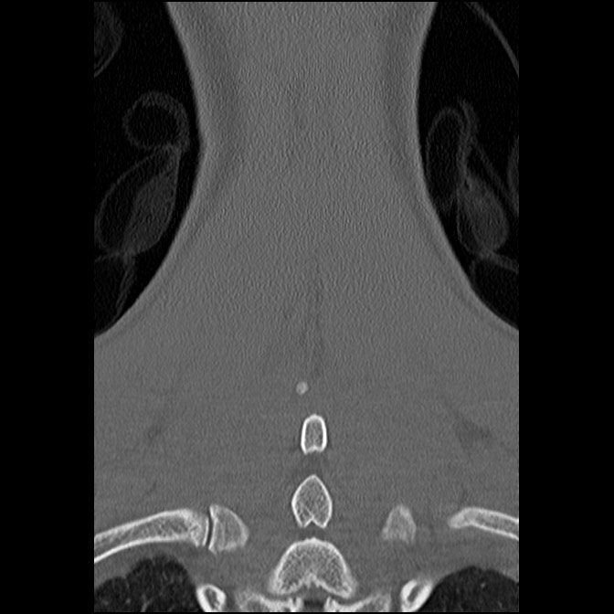 C5 facet fracture (Radiopaedia 58374-65499 Coronal bone window 53).jpg