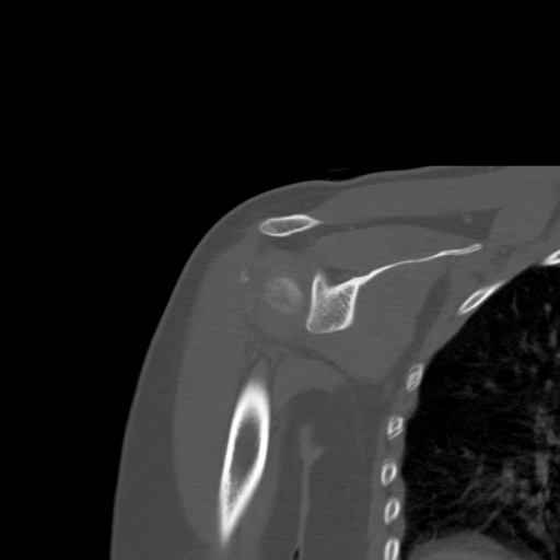 File:Calcific tendinitis of the infraspinatus tendon (Radiopaedia 87256-103539 Coronal bone window 31).jpg