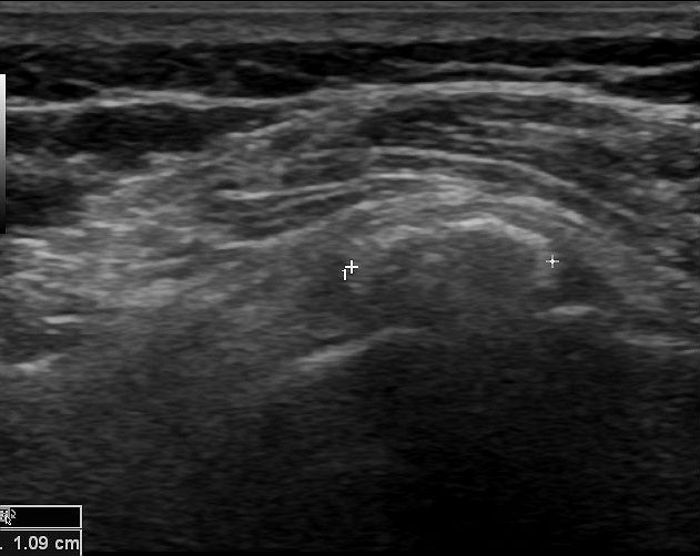 File:Calcific tendinosis of infraspinatus tendon (Radiopaedia 13406-13384 A 1).jpg