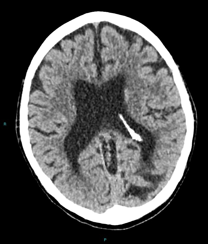 Calcified cerebral emboli from left ventricular thrombus (Radiopaedia 84420-99758 Axial non-contrast 43).jpg