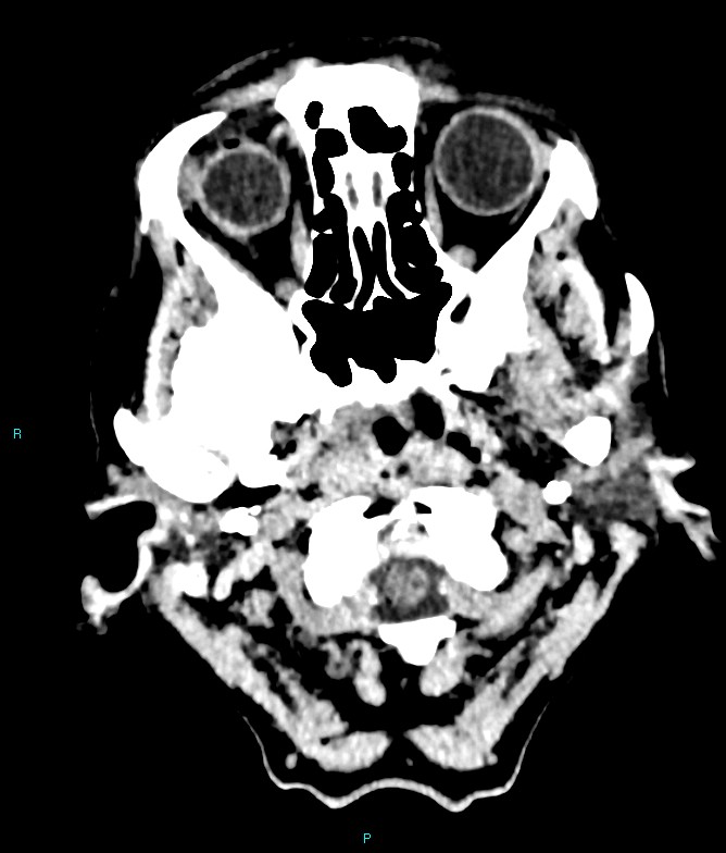 Calcified cerebral emboli from left ventricular thrombus (Radiopaedia 84420-99758 Axial non-contrast 84).jpg
