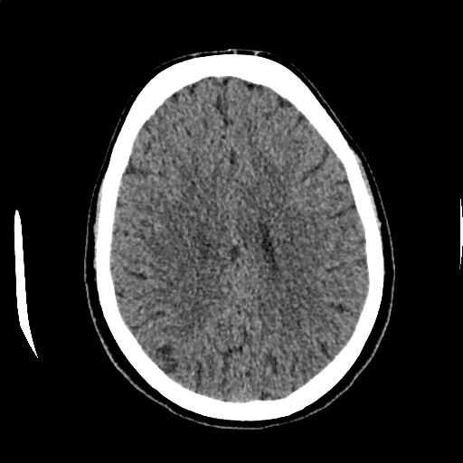 Calcified cerebral hydatid cyst (Radiopaedia 65603-74717 Axial non-contrast 51).jpg