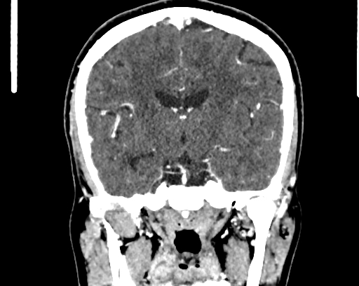 Calcified cerebral hydatid cyst (Radiopaedia 65603-74717 C 36).jpg