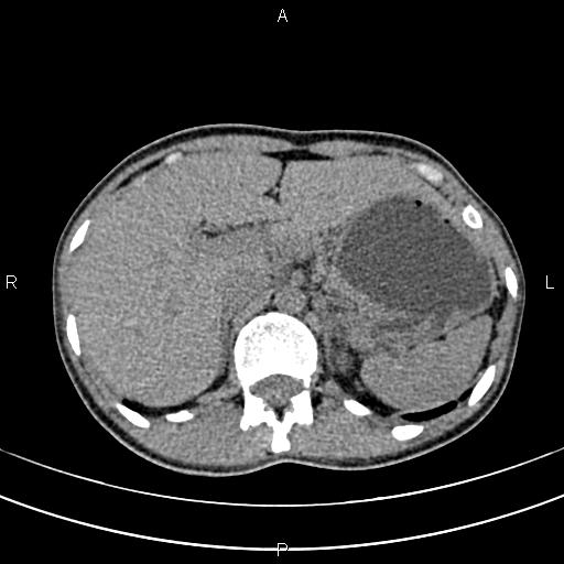 File:Calcified hepatic hydatid cyst (Radiopaedia 83870-99072 Axial non-contrast 45).jpg