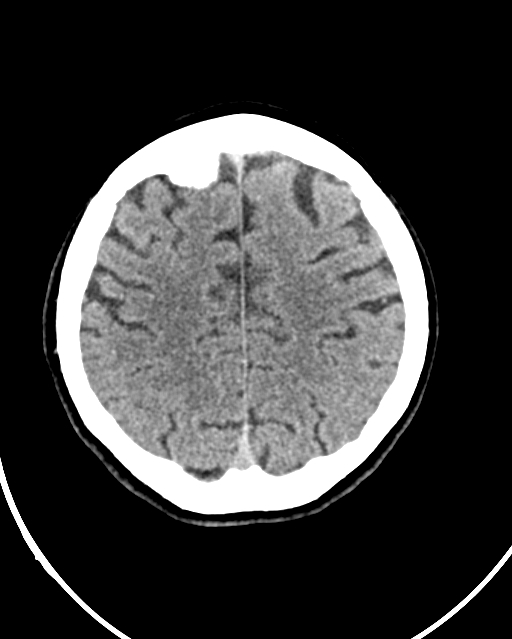 Calcified meningioma (Radiopaedia 74361-85243 Axial non-contrast 14).jpg