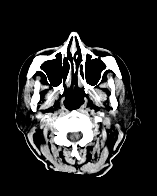 Calcified meningioma (Radiopaedia 74361-85243 Axial non-contrast 55).jpg