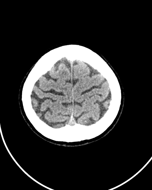 Calcified meningioma (Radiopaedia 74361-85243 Axial non-contrast 8).jpg