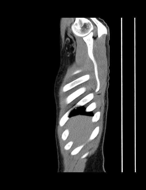 Calcifying pulmonary metastases (Radiopaedia 33359-34396 C 69).jpg