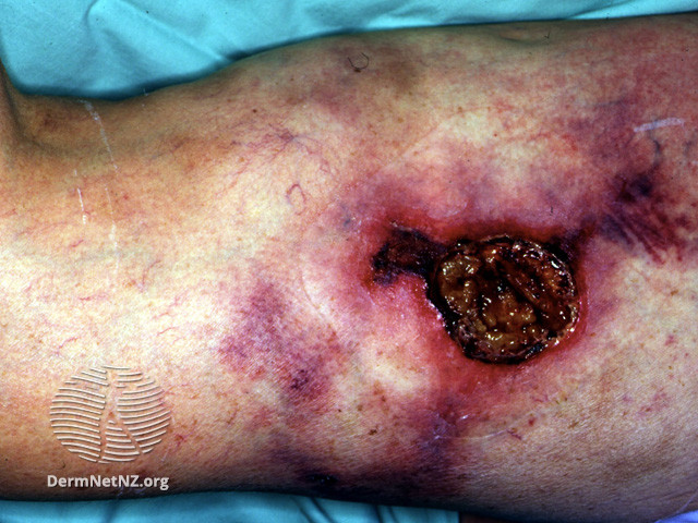 File:Calciphylaxis can lead to- (DermNet NZ systemic-calciphylaxis4).jpg