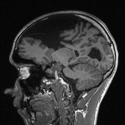 Callosal dysgenesis with interhemispheric cyst (Radiopaedia 53355-59335 Sagittal T1 74).jpg