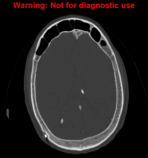 Calvarial thickening from chronic shunting (Radiopaedia 60079-67637 Axial bone window 111).jpg