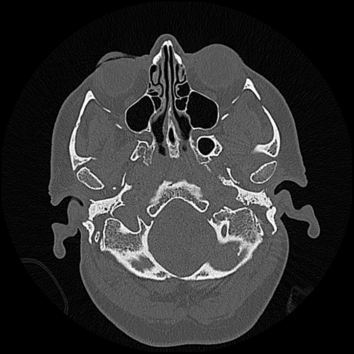 Canal up mastoidectomy (Radiopaedia 78108-90638 Axial bone window 28).jpg