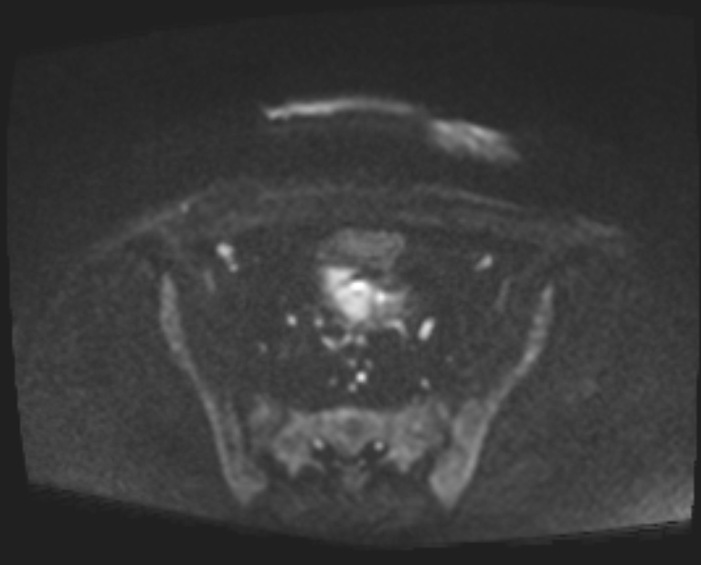 Cancer cervix - stage IIb (Radiopaedia 75411-86615 Axial DWI 80).jpg