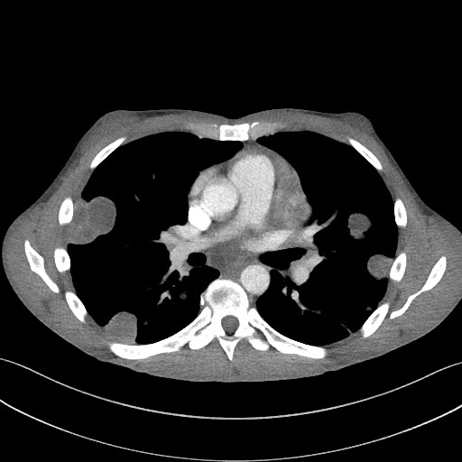 Cannonball metastases - testicular choriocarcinoma (Radiopaedia 84510-99891 B 59).jpg