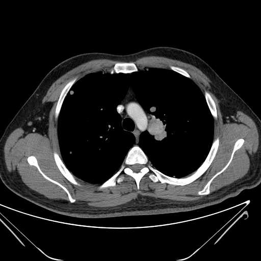 File:Cannonball pulmonary metastases (Radiopaedia 67684-77101 D 88).jpg