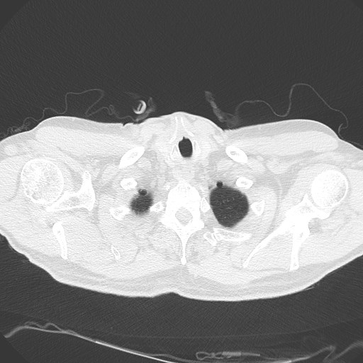 Caplan syndrome (Radiopaedia 56667-63530 Axial lung window 18).jpg