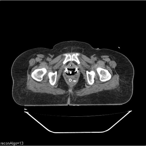 File:Carcinoma cervix- brachytherapy applicator (Radiopaedia 33135-34173 Axial non-contrast 42).jpg
