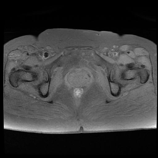 File:Carcinoma of the cervix (Radiopaedia 89018-105858 Axial T1 fat sat 14).jpg