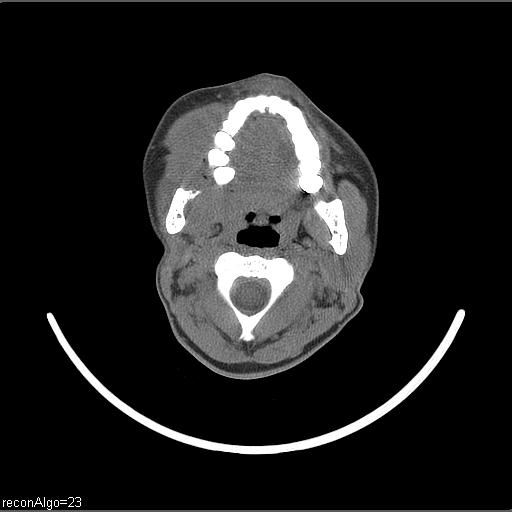 Carcinoma of the maxillary antrum (Radiopaedia 53805-59888 Axial non-contrast 48).jpg