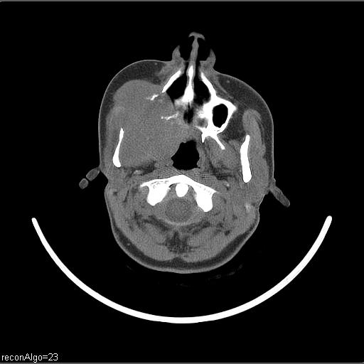 File:Carcinoma of the maxillary antrum (Radiopaedia 53805-59888 Axial non-contrast 55).jpg