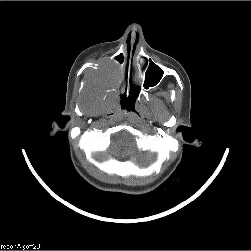File:Carcinoma of the maxillary antrum (Radiopaedia 53805-59888 Axial non-contrast 60).jpg