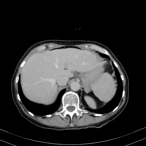 Carcinosarcoma (Radiopaedia 70401-80503 A 12).jpg