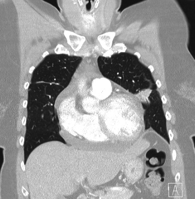 Cardiac sarcoidosis (Radiopaedia 74548-85534 Coronal lung window 19).jpg