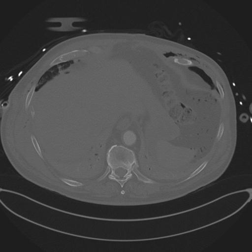 Cardiac trauma (Radiopaedia 32874-33858 Axial bone window 76).jpg