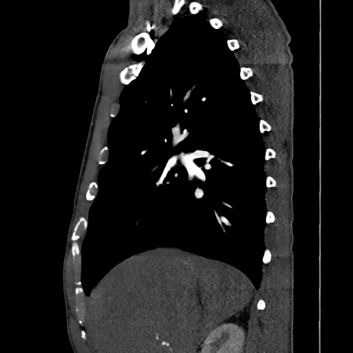 Cardiac tumor - undifferentiated pleomorphic sarcoma (Radiopaedia 45844-50134 B 56).png