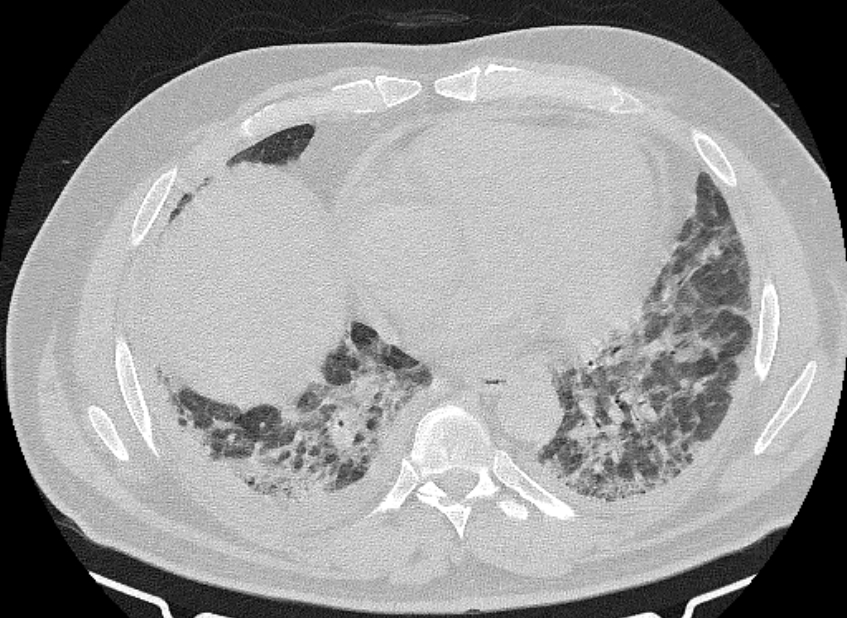 Cardiogenic pulmonary edema (Radiopaedia 68180-77678 Axial lung window 66).jpg