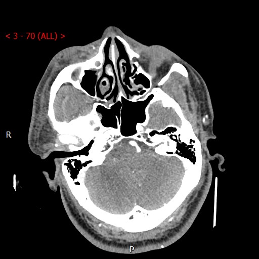Caroticocavernous fistula (Radiopaedia 42346-45457 B 1).jpg