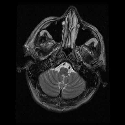 File:Carotid arterial dissection (Radiopaedia 30001-30547 Axial T2 8).jpg