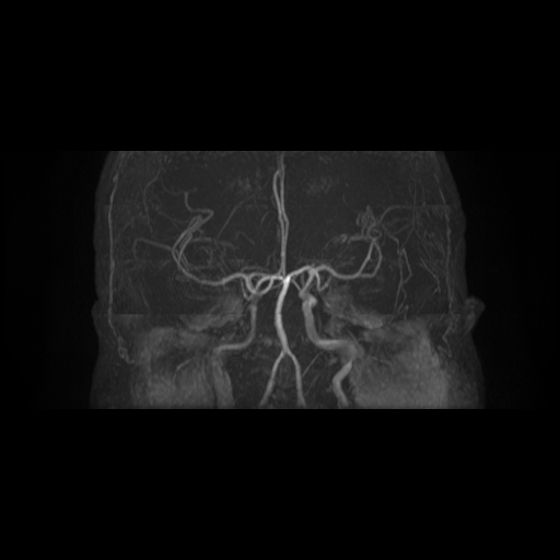 File:Carotid arterial dissection with acute cerebral infarction (Radiopaedia 26636-26784 MRA 11).jpg
