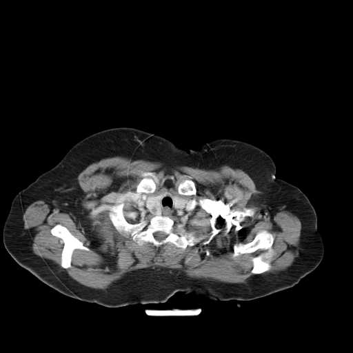 File:Carotid body tumor (Radiopaedia 21021-20948 A 25).jpg