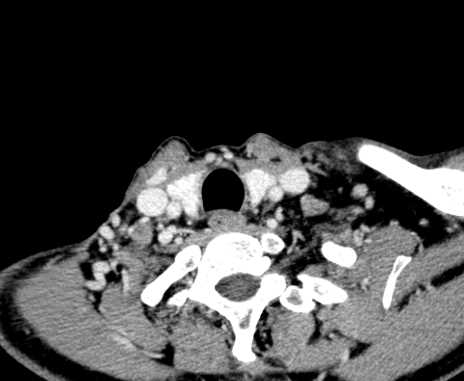 Carotid body tumor (Radiopaedia 61750-69757 Axial Post contrast 101).jpg